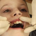 Daug kas to nežino: nemokama procedūra, po kurios dantys negenda