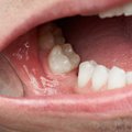 Specialistas: kada neverta delsti traukti danties ir kaip elgtis jį išrovus