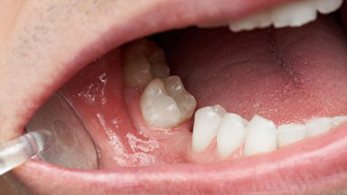 Odontologas įvardijo pagrindinę priežastį, dėl kurios prarandame dantis