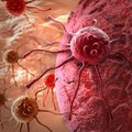 Burnos vėžys: kaip pastebėti pirmuosius simptomus?