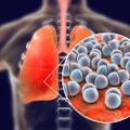Vaistinėse jau galima pasiskiepyti nuo pneumokoko: kam ši liga pavojingiausia?