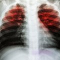 TB cases among Lithuanian children on rise, treatment results worst in Europe