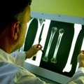 Mokslininkai: kaulų lūžių gydymo metodai nesikeitė pusantro tūkstančio metų