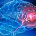 Išvardijo, kam reikėtų pasitikrinti dėl smegenų aneurizmos: dauguma jos plyšimų baigiasi mirtimi