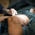 Kojų venų operacijos turi būti atliekamos nemokamai: ligonių kasos nurodė, ką svarbu žinoti pacientui
