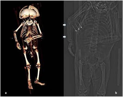 Austrijos aristokratų vaikas mirė dėl saulės trūkumo. Andreas G. Nerlich et al., in Frontiers in Medicine nuotr.