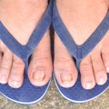 Pėdų grybelis: gydymas ir prevencija