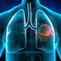 Ar tikrai ivermektinas gydo plaučių vėžį?