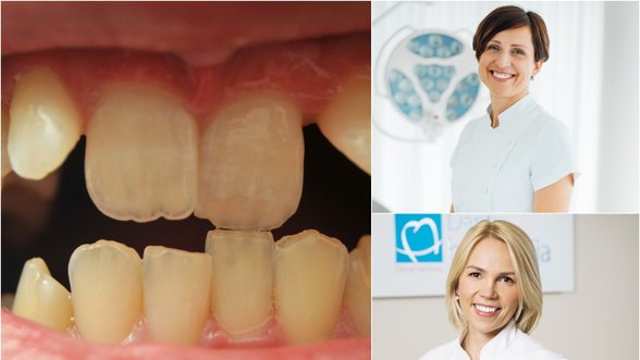 Tiesinti dantis būtina ne tik dėl grožio: kas gali grėsti ir kodėl nepatariama laukti?