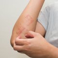 Apie lėtinę odos ligą praneša niežulys: kenčia ir vaikai, ir suaugusieji
