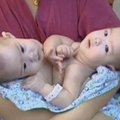 Kinijoje gydytojai sėkmingai atskyrė suaugusias dvynes