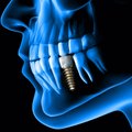 Ilgalaikiai sprendimai netekus dantų: implantų privalumai ir trūkumai